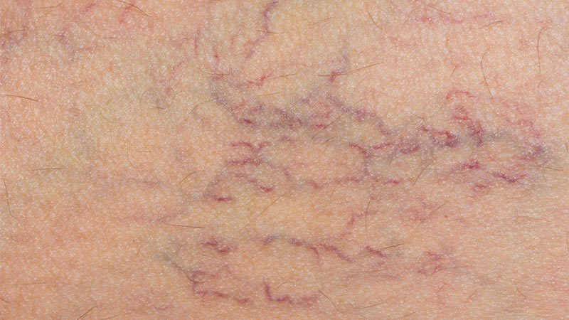 Causes of spider veins varicose veins and hemorrhoids during pregnancy Varicose Veins And Spider Veins Treatment Dr Maurizio Rodio
